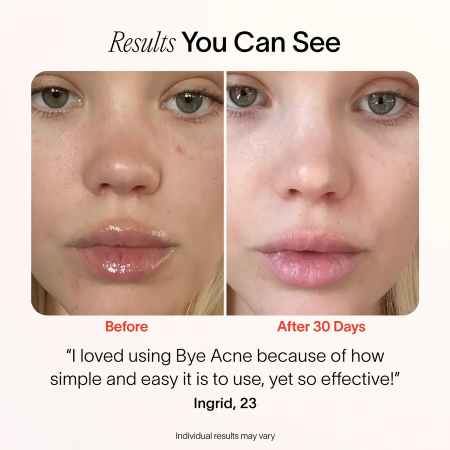 Solawave Bye Acne user before and after results