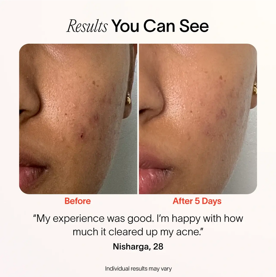 Solawave Bye Acne before and after results